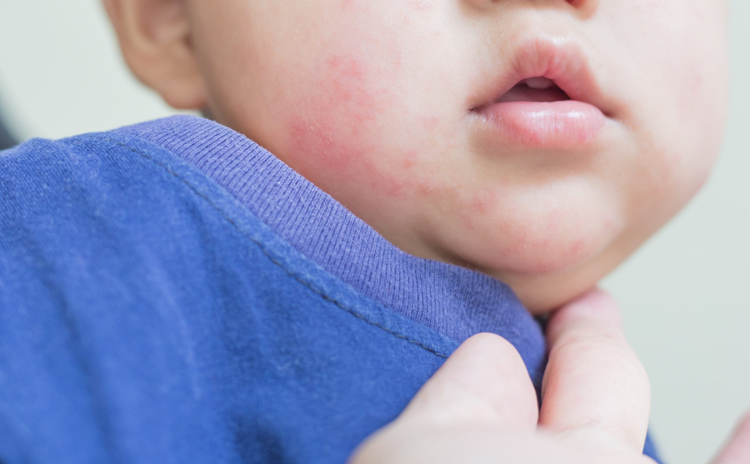Panduan Lengkap: Cara Mengatasi Alergi Makanan pada Bayi Anda